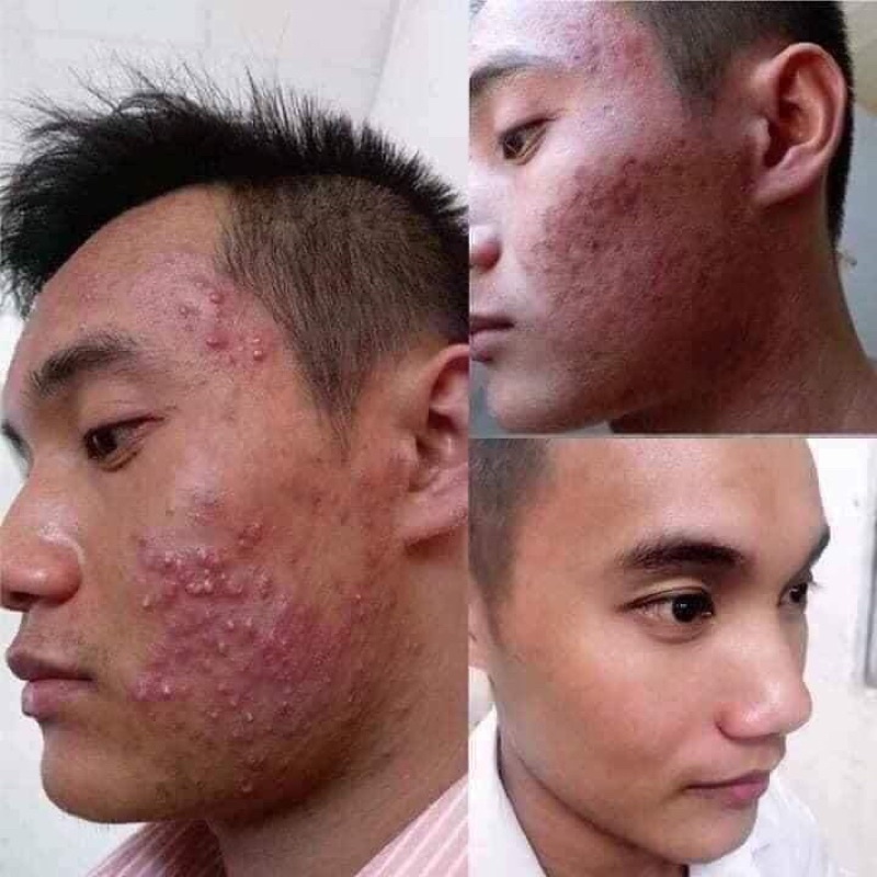 Serum Diếp Cá: - Sạch bay tất cả các loại mụn sau 7 ngày! - Sạch thâm, da sáng đều màu! - Kiềm dầu, se khít | BigBuy360 - bigbuy360.vn