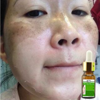 COMBO KEM LỘT TRẮNG DA NÁM