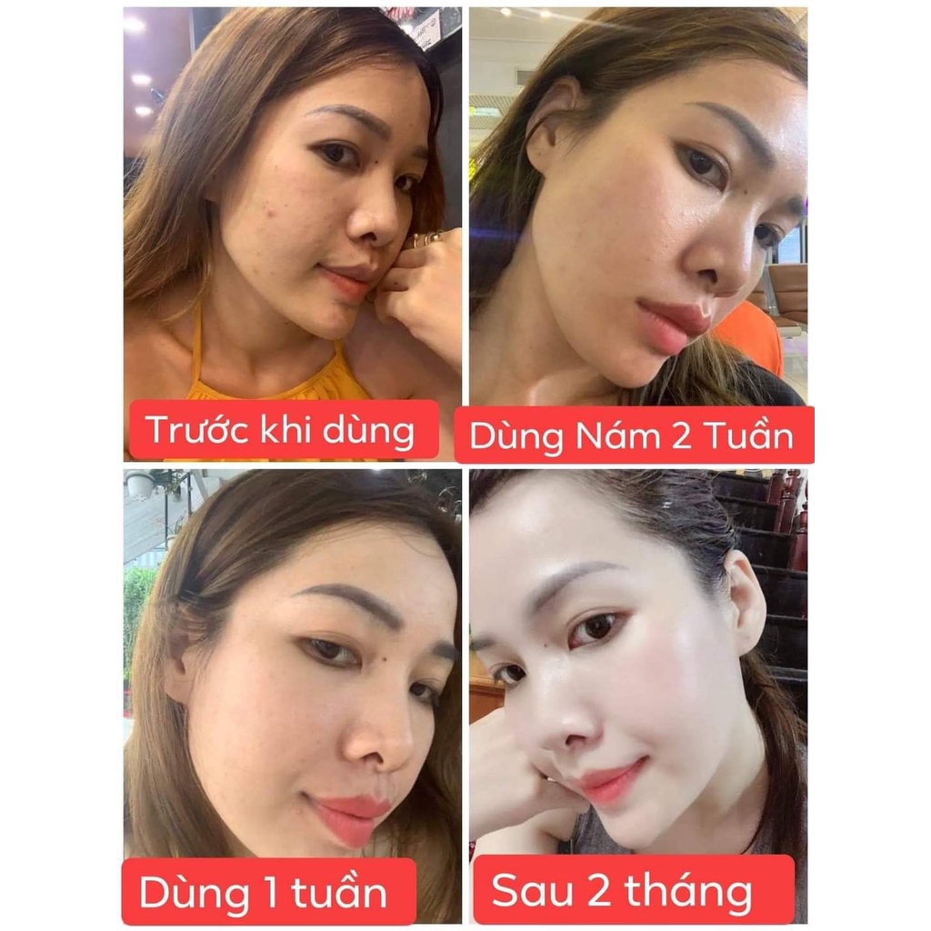 Vua khử nám - Siêu trắng - Chống nắng - Tàn nhang