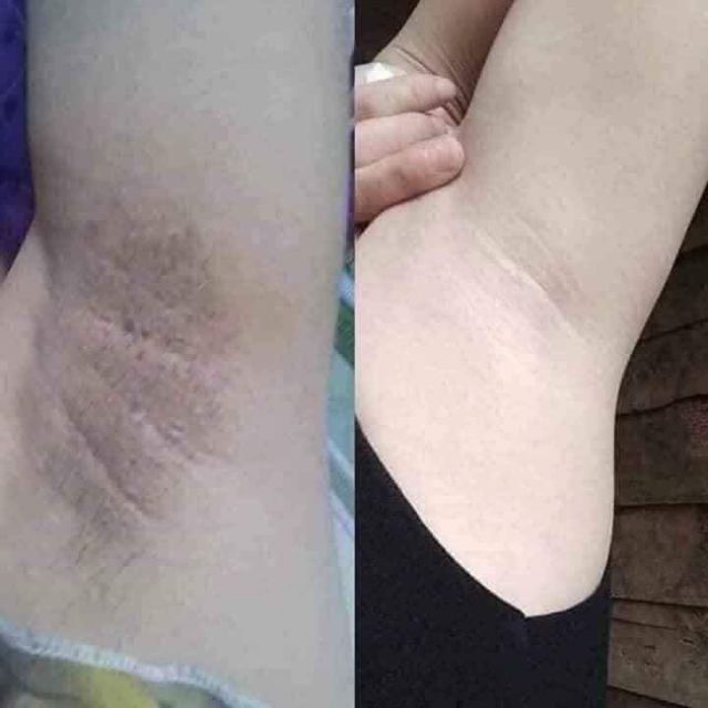 [HÀNG CHÍNH HÃNG] Siêu Trị Thâm Hôi Nách, Trị Thâm Mông,Trị Thâm Bikini BIHO LADI 5g | BigBuy360 - bigbuy360.vn