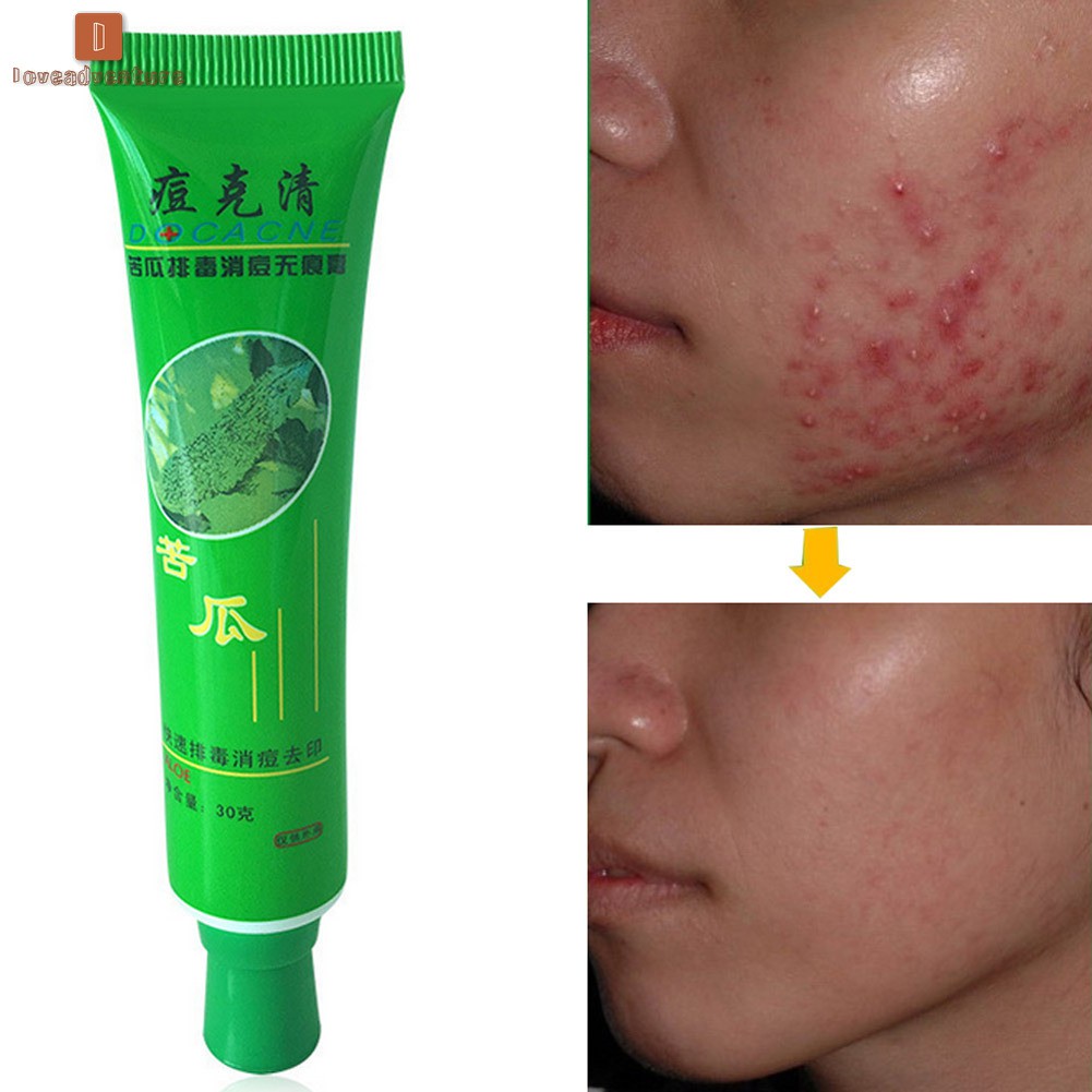 Kem Hỗ Trợ Giảm mụn / sẹo và kiềm dầu 30g nhãn hiệu DOCACNE