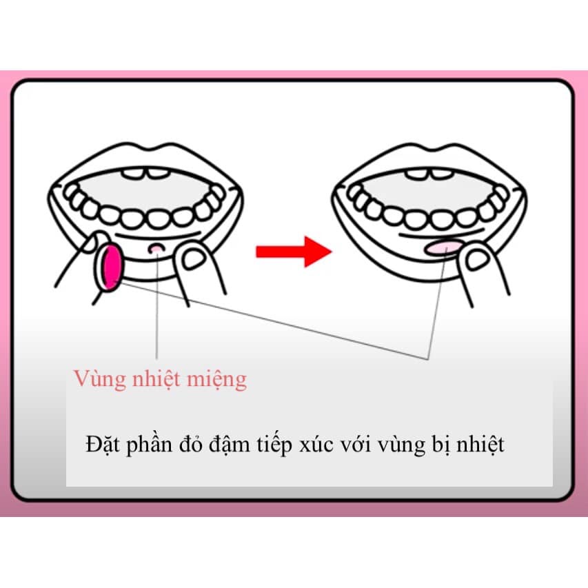 Miếng Dán Vết Nhiệt Miệng, Lỡ Miệng Taisho Nội Địa Nhật