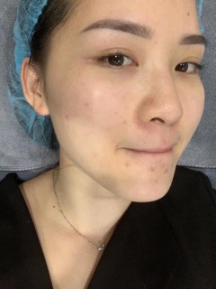 SERUM ĐĂC TRỊ NÁM MỤN CC MELANO