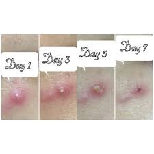 Miếng dán mụn / dán phỏng hydrocolloid Somaderm - HSD: 01/2025 | BigBuy360 - bigbuy360.vn