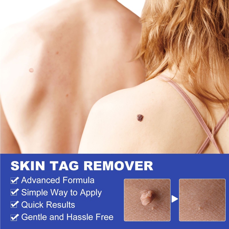 Thiết Bị Loại Bỏ Mụn Thịt Dư Trên Da Tiện Dụng