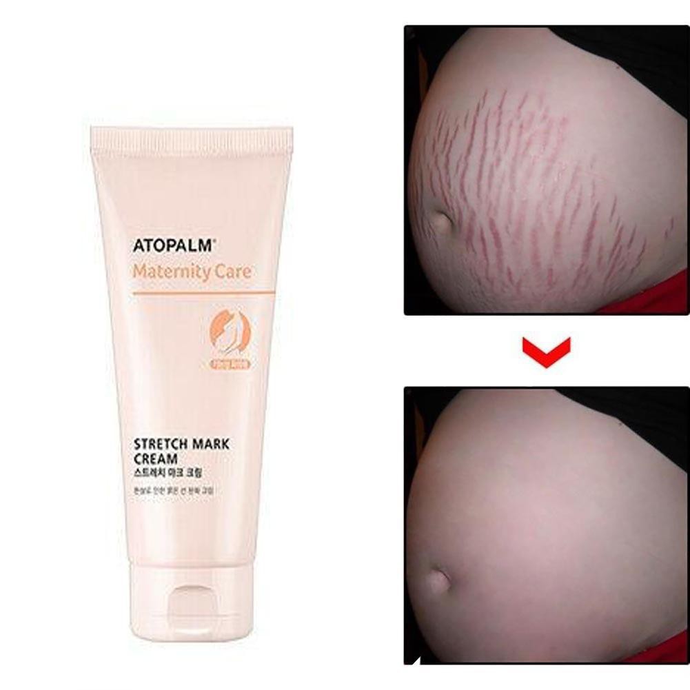 Kem trị rạn da bà bầu hiệu quả ATOPALM Maternity Care Stretch Mark Cream 150ml