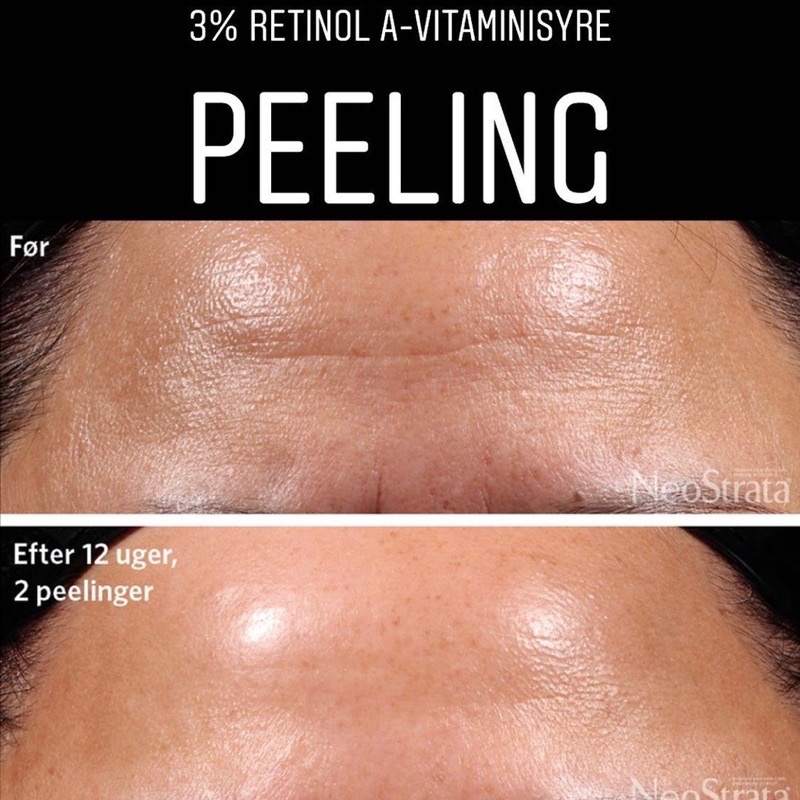 ✅ Neostrata Peel Tái Tạo Da, Giảm Nếp Nhăn Ngăn Ngừa Lão Hóa Prosystem Retinol Peel 1.5ml