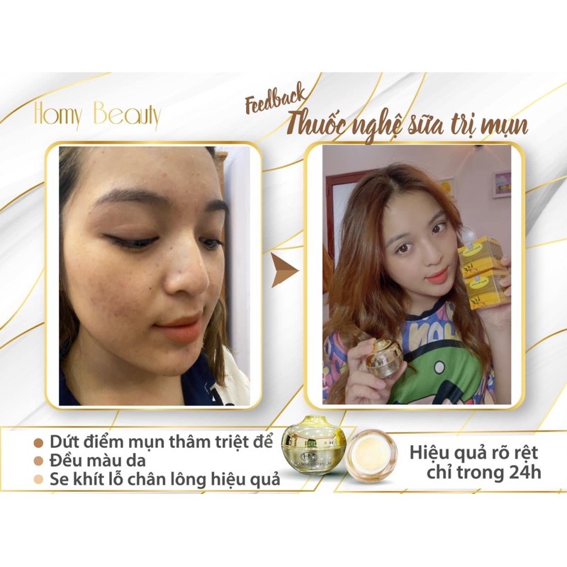 KEM NGHỆ SỮA GIẢM MỤN THÂM HOMY [ Cứu Tinh Cho Làn Da Mụn ] | BigBuy360 - bigbuy360.vn