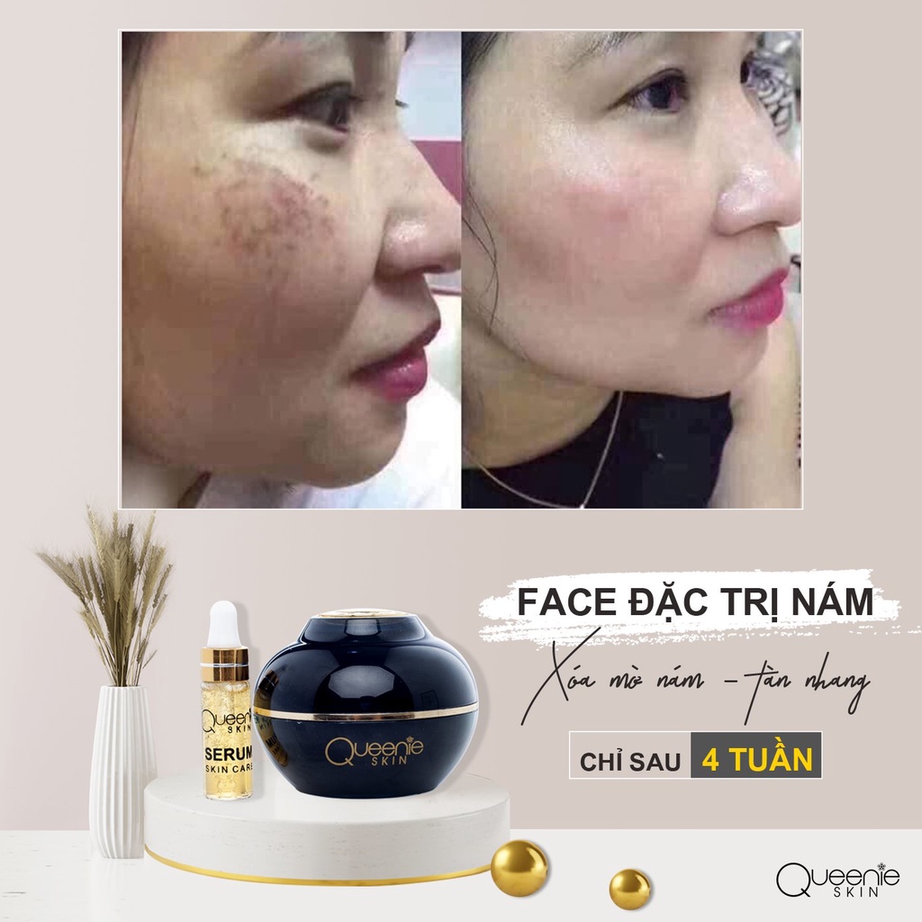 [FreeShip + Tặng Viên Uống &amp; Huyết Thanh Trắng Da] Kem Nám Queenie Skin Chính Hãng - Kem Ngừa Nám Queenie Skin Date 2024
