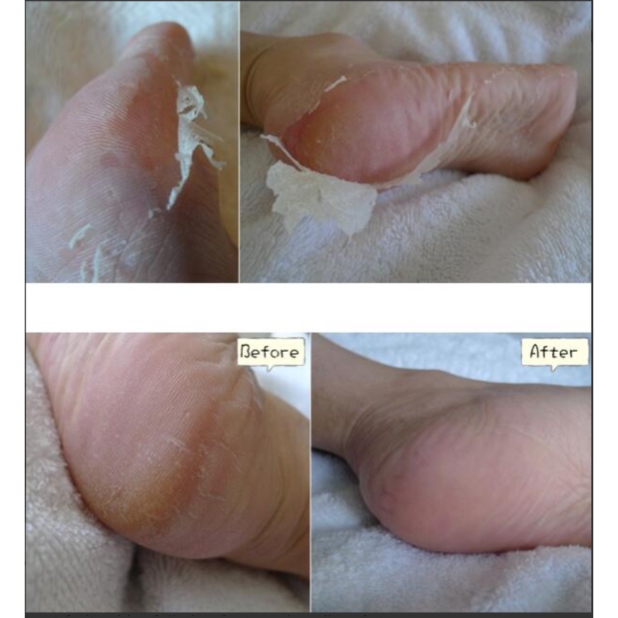 MẶT NẠ Ủ CHÂN PEEL DA GÓT CHÂN KHÔ VÀ NỨT NẺ BABY FOOT NHẬT BẢN