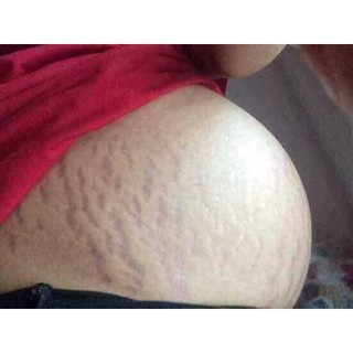 MỠ TRĂN TRỊ DẠN DA