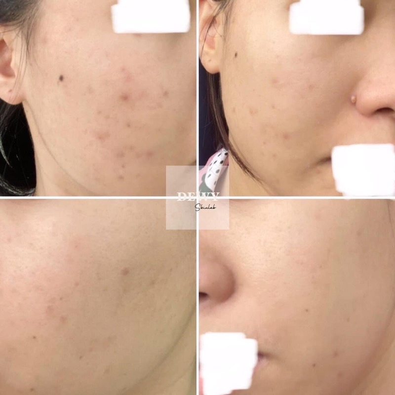 Kem Ngừa Nám Và Tàn Nhang Melasma-X 3D Whitening Clinic Cream