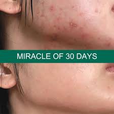 Some By Mi - Bộ Giảm Mụn Some By Mi AHA BHA PHA 30 Days Miracle Chính Hãng