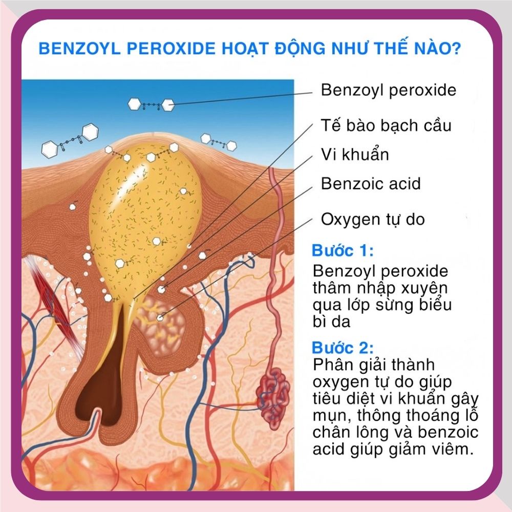 Gel bôi mụn EzoyB 5 - EzoyB 10 giảm mụn hiệu quả 10g - Dược mỹ phẩm chính hãng Derma Touch