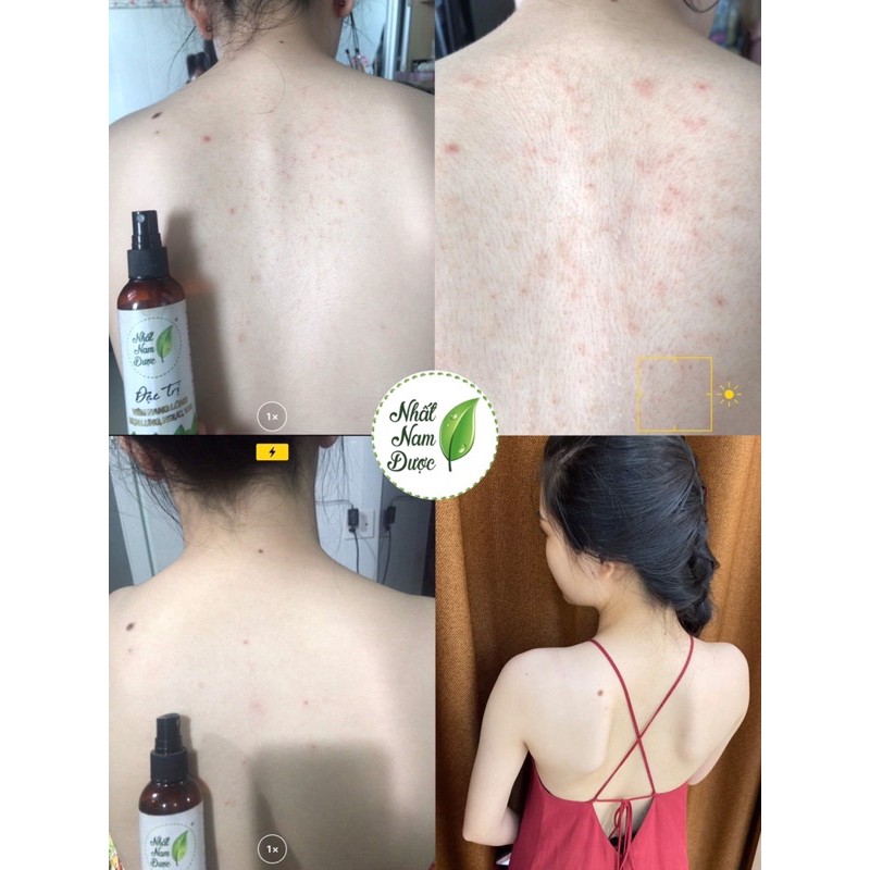 Xịt mụn lưng Nhất Nam dược ⚡️Freeship ⚡️ đánh bay mụn, thâm, viêm nang lông trên cơ thể. | BigBuy360 - bigbuy360.vn