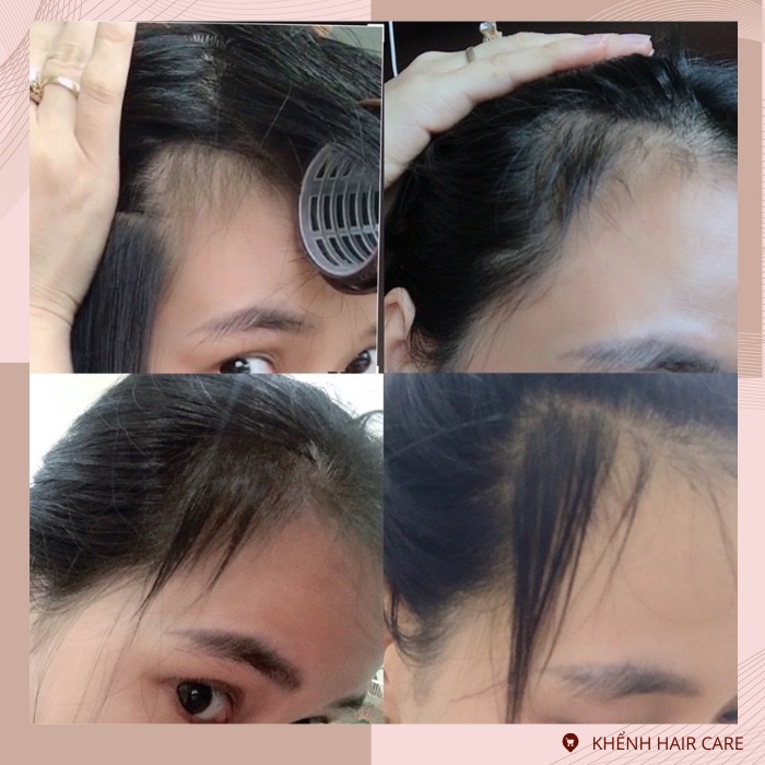 Combo Chăm Sóc Tóc 5 Món Kích Thích Mọc Tóc Và Dưỡng Tóc