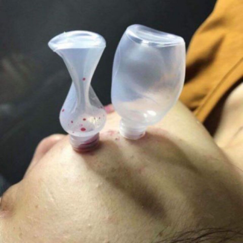 Ống Hút Máu Bầm ( Chất Liệu Nhựa Dẻo, Dung Tích 5ml )