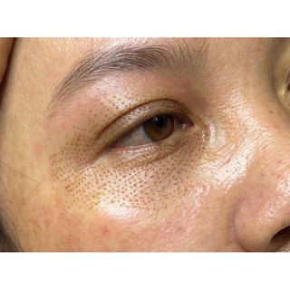 Máy Nhấn Mí Plasma