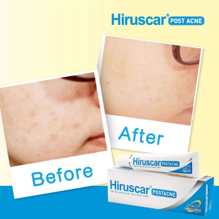 Hiruscar Post Acne 10g - kem hỗ trợ cải thiện sẹo hiệu quả - cvspharmacy