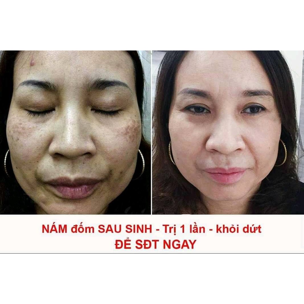 Dưỡng da giảm mụn, xoá nám tàn nhang 1T