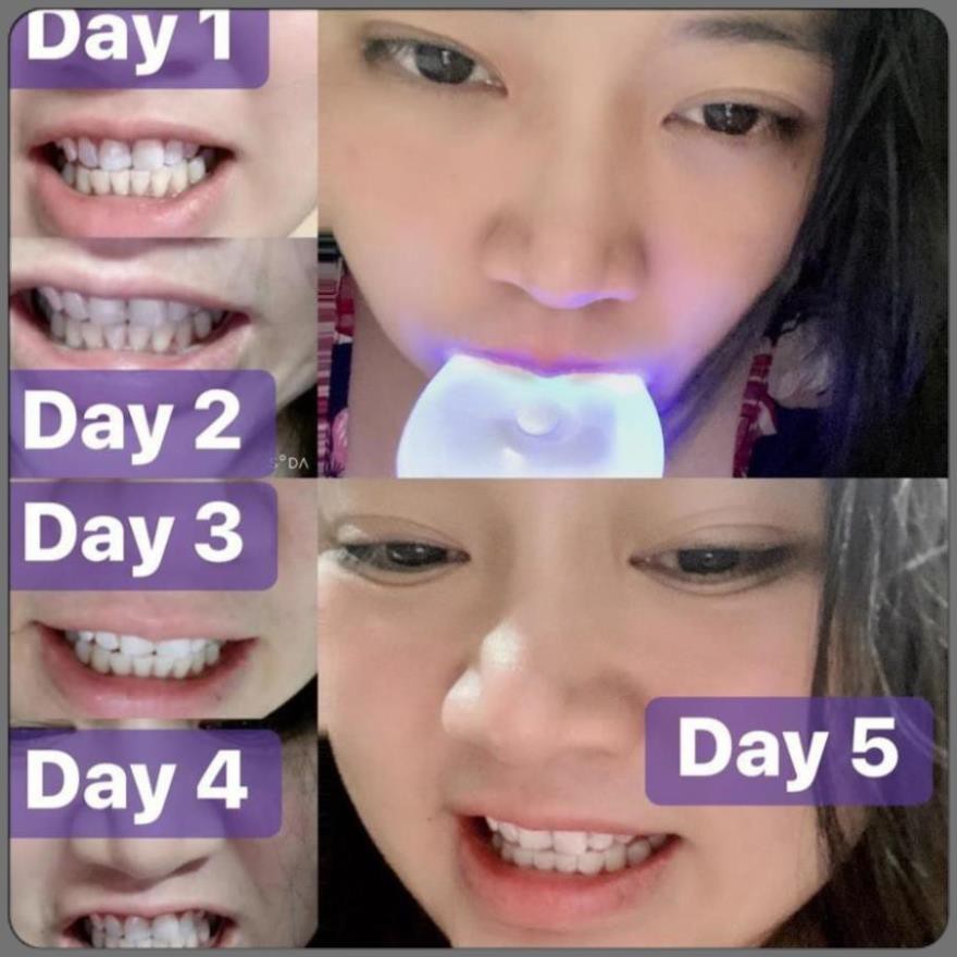 [ Hàng ÚC] Máy làm trắng răng bằng ánh sáng xanh White Glo White Accelerator Blue Light Teeth Whitening System