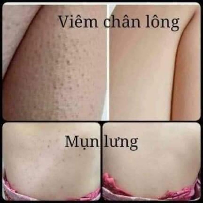 Xà phòng ngừa mụn lưng For Back Nhật Bản - Bánh 135g