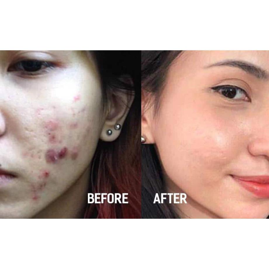 Gel Chấm Mụn Farmona Dermacos Anti Acne Imperfection Spot Gel giảm mụn, chứa bùn hoạt tính