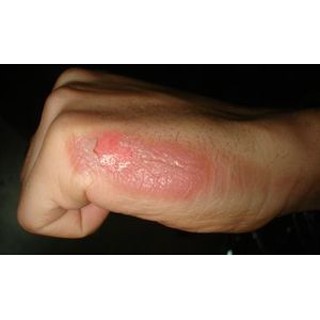 Xịt bỏng Panthenol Xịt Mẫu Mới ✅(Chính Hãng 100%)