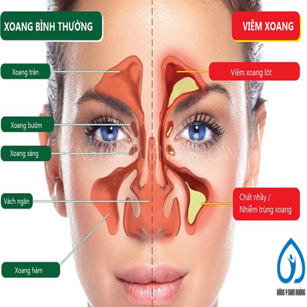 [A CHÈN] [GIA TRUYỀN] Dược phẩm xịt viem xoang viem mui di ung