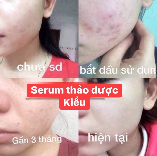 Serum Kiều beautyqueen_date mới 2020