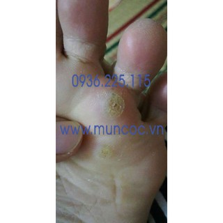 [CHÍNH HÃNG] Miếng dán mụn cóc, mắt cá chân Plasters hộp 18 miếng