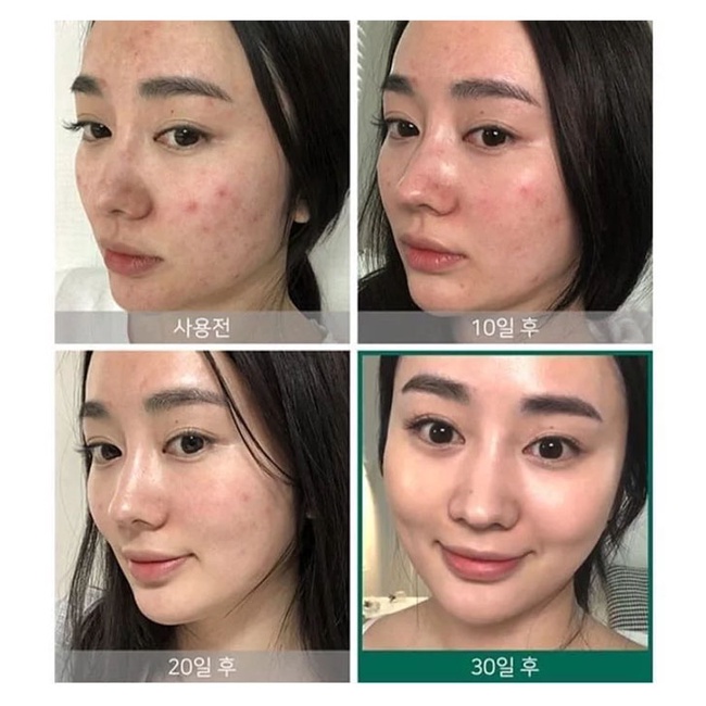 Bộ Kit Some By Mi AHA-BHA-PHA Dành Cho Da Mụn 4 Món AHA-BHA-PHA 30 Days Miracle AC SOS Kit