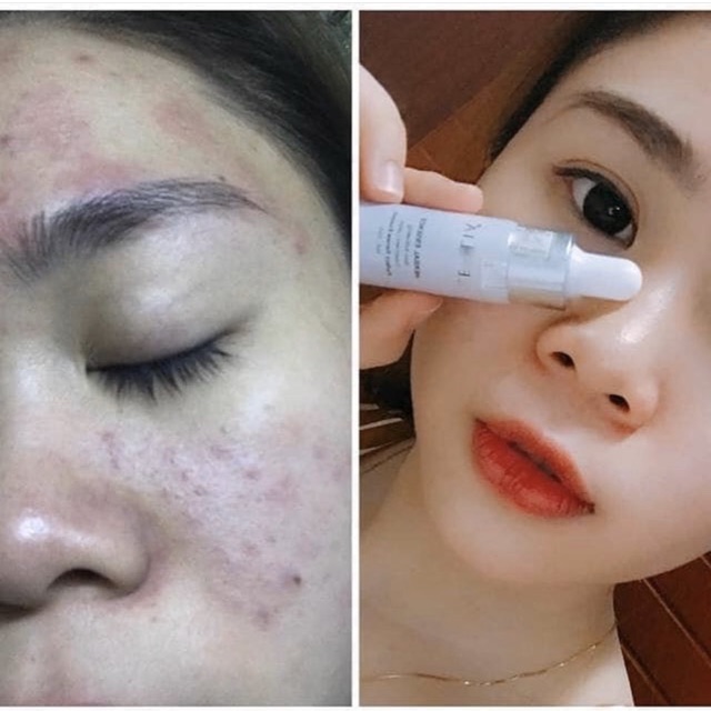 Essence CENLIA 🔥[ CHÍNH HÃNG ] tạm biệt mụn, tạm biệt lỗ chân lông to, không để lại sẹo thâm, giúp da mịn màng sạch mụn | BigBuy360 - bigbuy360.vn