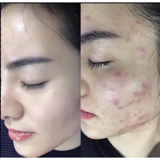 Kem chấm mụn Derma Forte 15g