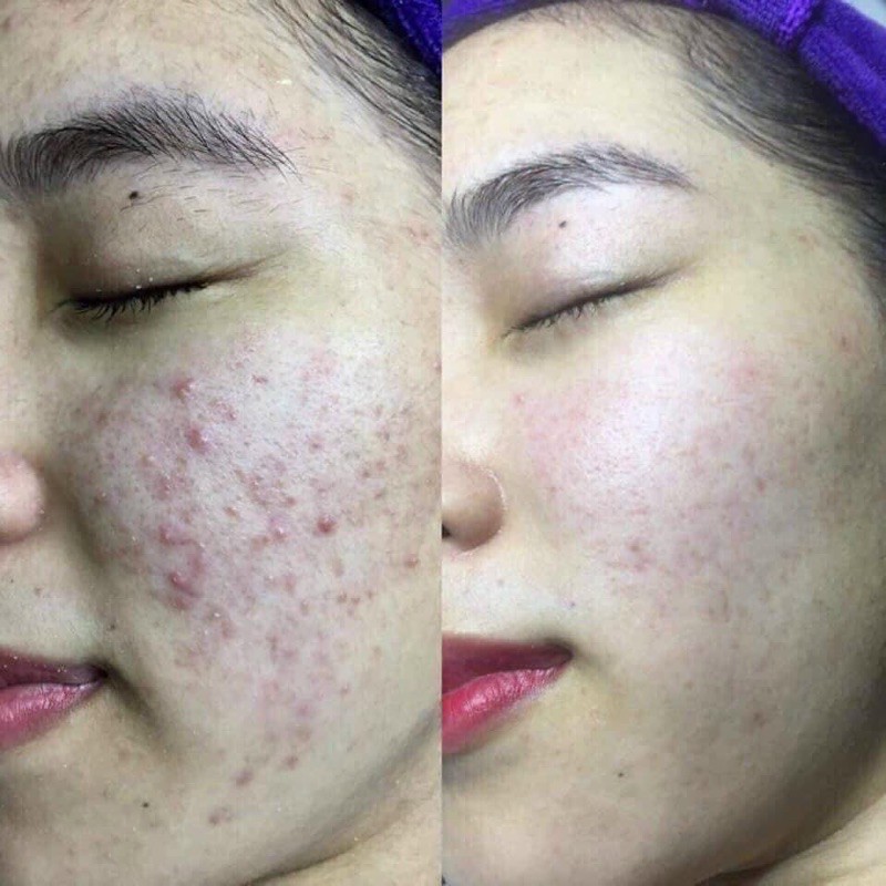 Serum mụn thảo dược LaDy | BigBuy360 - bigbuy360.vn