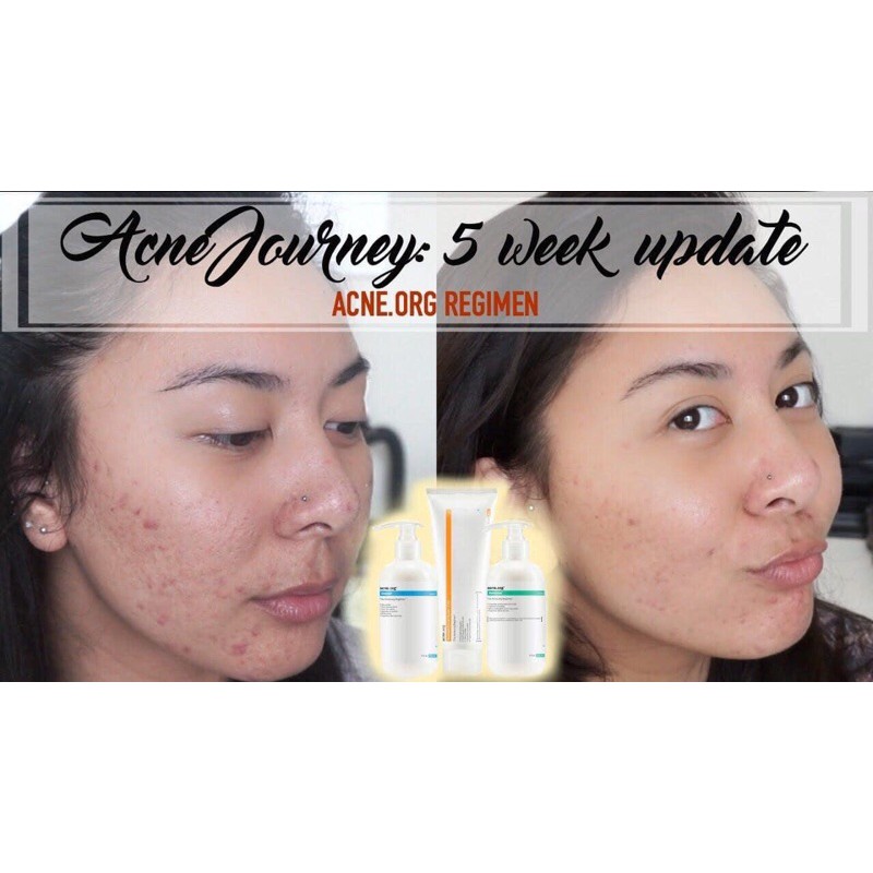 Kem chấm mụn treatment acne.org benzoyl peroxide - Chính hãng