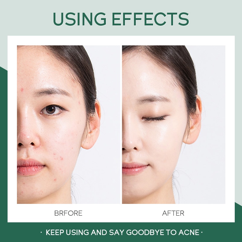 Gel hỗ trợ giảm mụn FENYI 20g chiết xuất tràm trà làm dịu da làm sạch lỗ chân lông