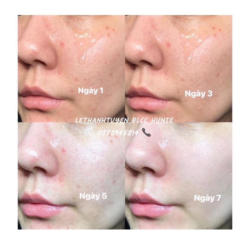SERUM DƯỠNG DA HUNIE ( CHÍNH HÃNG ) TẶNG KÈM QUÀ | BigBuy360 - bigbuy360.vn