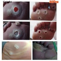 6 Miếng dán tẩy mụn cóc, mụn nhọt vết chai, mắt cá chân