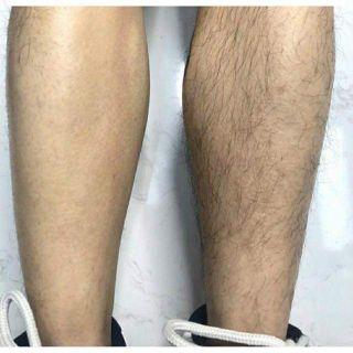 Xịt Tẩy Lông Baimiss Nội Địa Trung