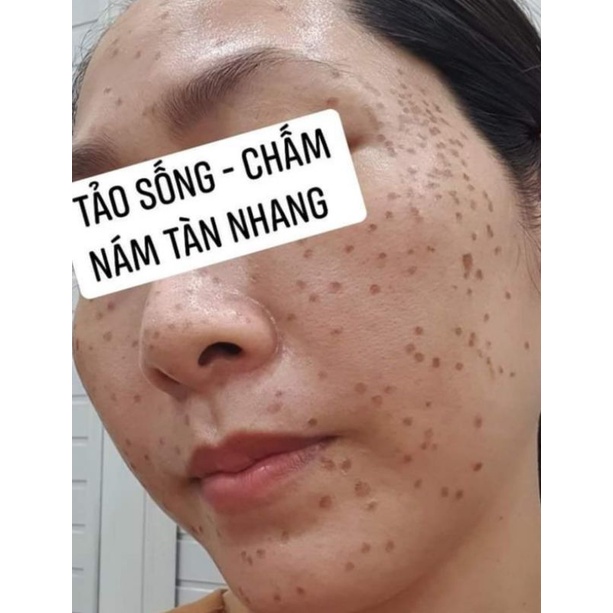 Combo 2 sp chấm nám tàn nhang.