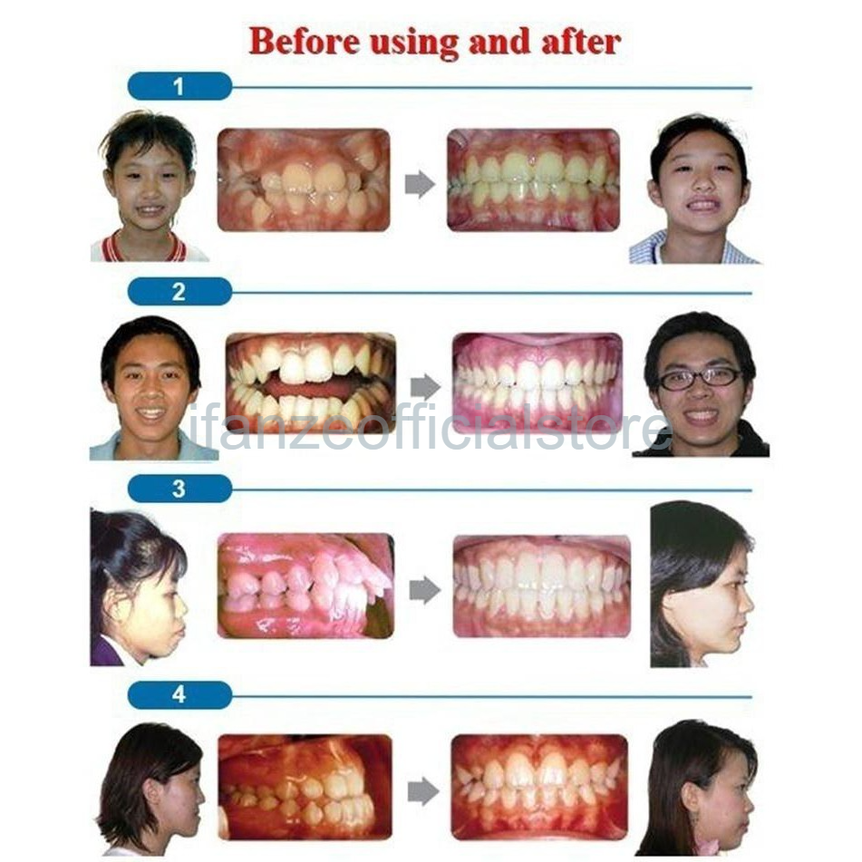 [Hàng mới về] Bộ 3 hàm niềng năng chỉnh nha/ làm trắng răng 3 giai đoạn dành cho người lớn