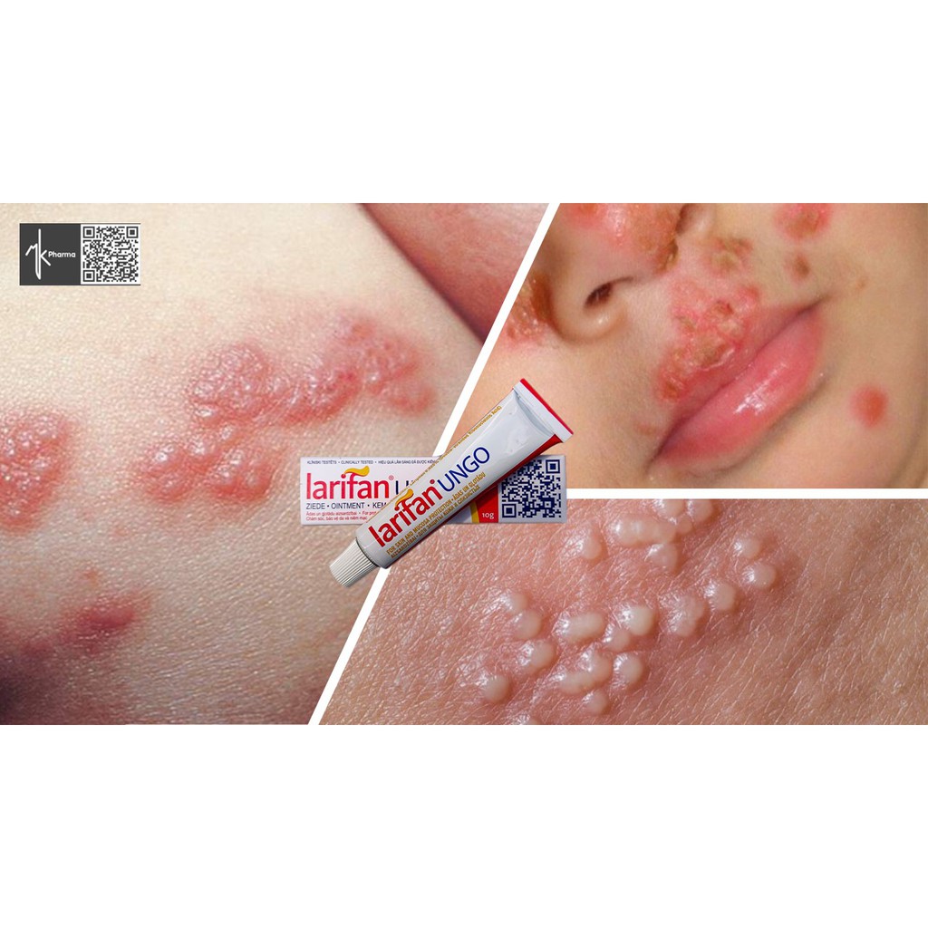 HERPES - MỤN RỘP TÁI PHÁT NHIỀU LẦN KHÔNG CÒN LÀ NỖI LO KHI CÓ KEM BÔI LARIFAN UNGO TỪ CHÂU ÂU