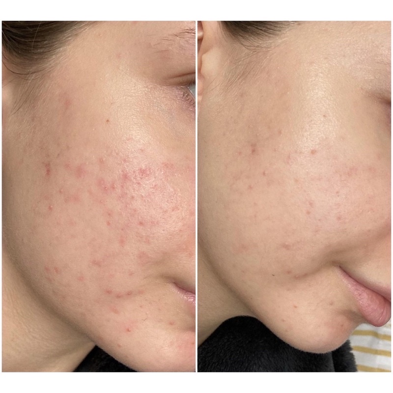 Tẩy da chết hóa học Alpha Hydrox AHA soufflé 12% Glycolic Aha | BigBuy360 - bigbuy360.vn