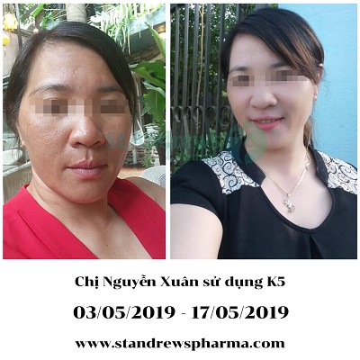 Kem Nám Tàn Nhang K5 Lipogel Hiệu Quả Tốt Nhất Trên Nám Mảng, Sau Sinh, Chân Sâu, Đồi Mồi [CHÍNH HÃNG ITALIA]