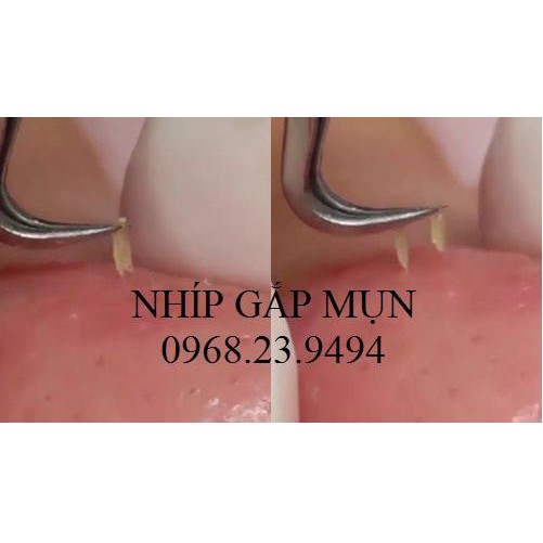 NHÍP GẮP MỤN