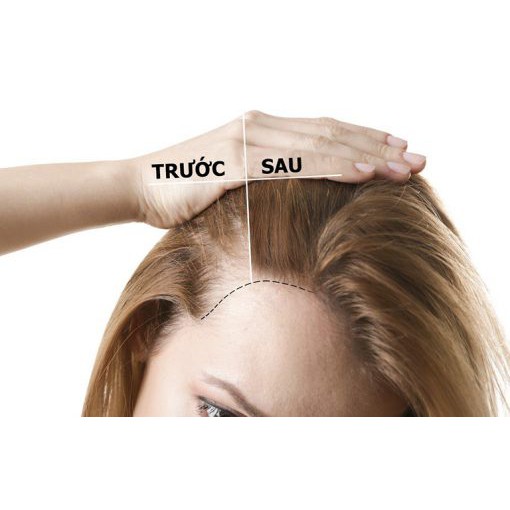 HOẠT CHẤT MỌC TÓC 5ML