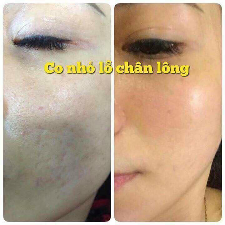 Tách Lẻ 1 ống Tế bào gốc Ala nâu 10ml | BigBuy360 - bigbuy360.vn