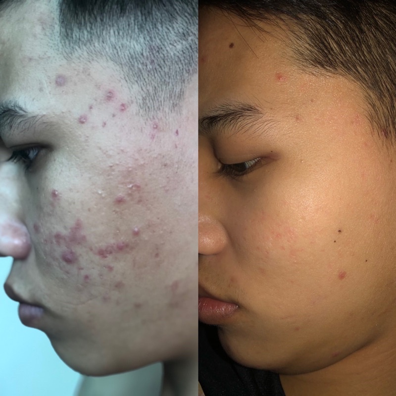 Serum 02 Plus Giảm Mụn Và Nám Nhẹ Bách Y Sâm