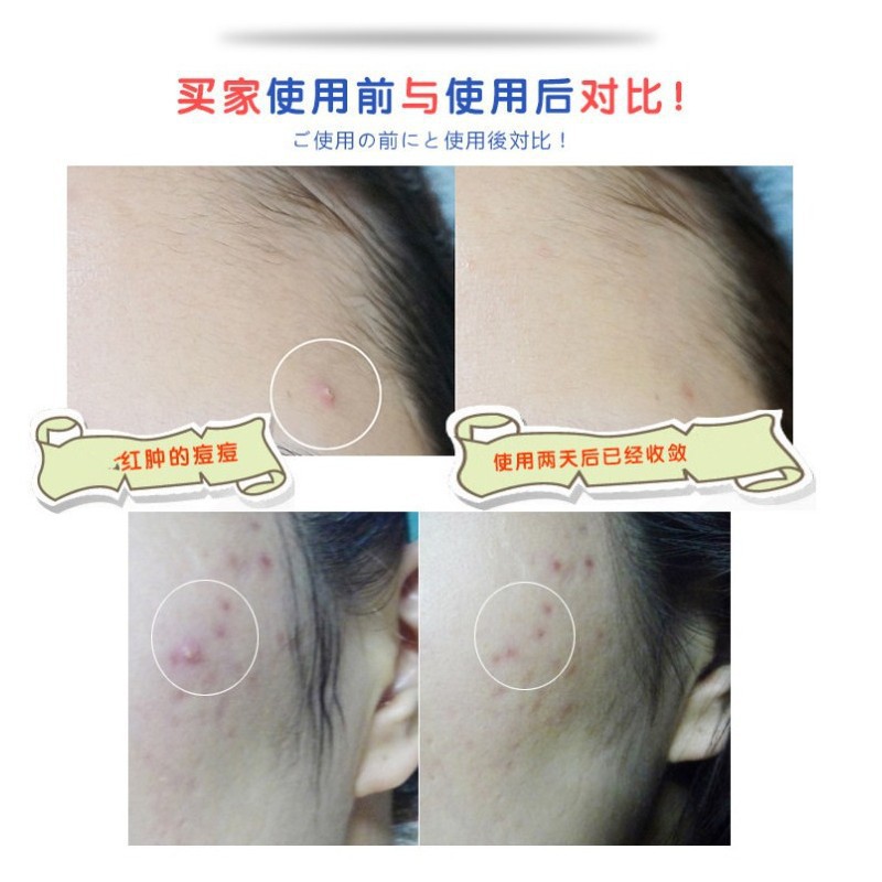 Kem hỗ trợ ngăn ngừa giảm  mụn Lion Pair Medicated Acne Care Cream W [Chính hãng]